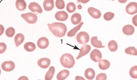 <p>What abnormal RBC shape is indicated?</p>