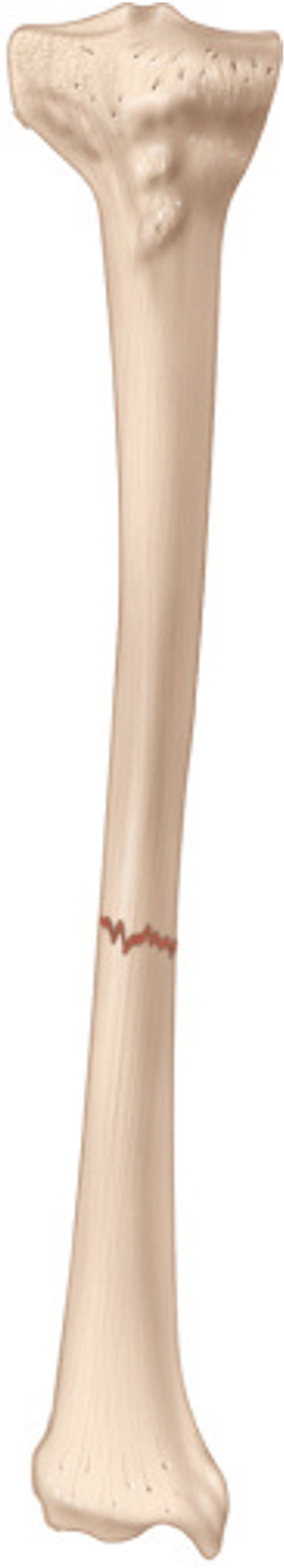 <p>straight ACROSS the bone shaft</p>