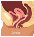 <p>Rectal prolapse (posterior), herniation of the posterior vaginal segment associated with descent of the rectum </p><p>-Presentation: bulge or pressure symptoms, constipation, incomplete emptying, lower back pain, sexual dysfunction</p><p>-Dx: pelvic exam, POP-Q, increase in defect with valsalva</p><p>-Tx: pessary, pelvic floor muscle exercises, surgical treatment </p>