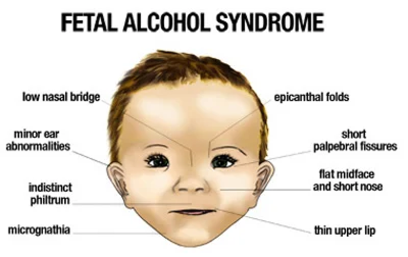 <ul><li><p>Pathophysiology</p><ul><li><p><span>ETOH crosses placenta: fetal blood ETOH ~ maternal ETOH</span></p></li></ul></li><li><p><span>Fetal alcohol spectrum disorder (FASD)</span></p><ul><li><p>No known amount where you could get it or you could not </p></li><li><p><span>Facial anomalies</span></p></li><li><p><span>Growth restriction</span></p></li><li><p><span>Microcephaly</span></p></li><li><p><span>Intellectual disability</span></p></li><li><p><span>Behavioral problems</span></p></li></ul></li><li><p><strong><span>One of the most common preventable causes of birth defects and childhood disabilities</span></strong></p></li><li><p><span>Management</span></p><ul><li><p><span>Behavioral therapy</span></p></li><li><p><span>Inpatient detox if severe dependence</span></p></li></ul></li><li><p><span>Breastfeeding:</span></p><ul><li><p><span>Avoid heavy use</span></p></li><li><p><span>Recommended to wait 3-4 hours after a single drink before breastfeeding</span></p></li><li><p><span>If ”buzzed”: alcohol is in the breastmilk</span></p></li></ul></li></ul><p></p><p></p>