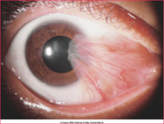 <p>More common in tropical regions, due to prolonged sun exposure</p><p>Fibrovascular triangular encroachment on the cornea</p><p>Can cause redness and irritation</p>