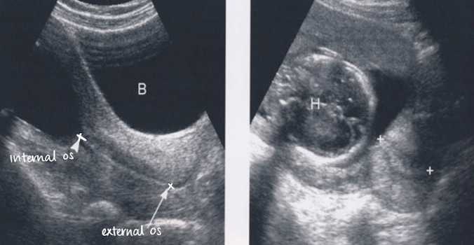 <ul><li><p>scan through amniotic fluid/bladder to image cervix</p></li><li><p>measure length of cervix from<span style="color: yellow;"> internal os to external os</span></p></li><li><p>do not include vaginal canal in measurement</p></li><li><p>pitfalls:</p><ul><li><p>maternal body habitus</p></li><li><p>full bladder can compress LUS and mimic a long closed cervix</p></li></ul></li></ul><p></p>