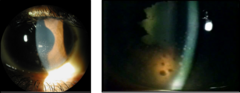 <p>•Glucocorticoids to reduce inflammation</p><p>•Ophthalmology consult</p>