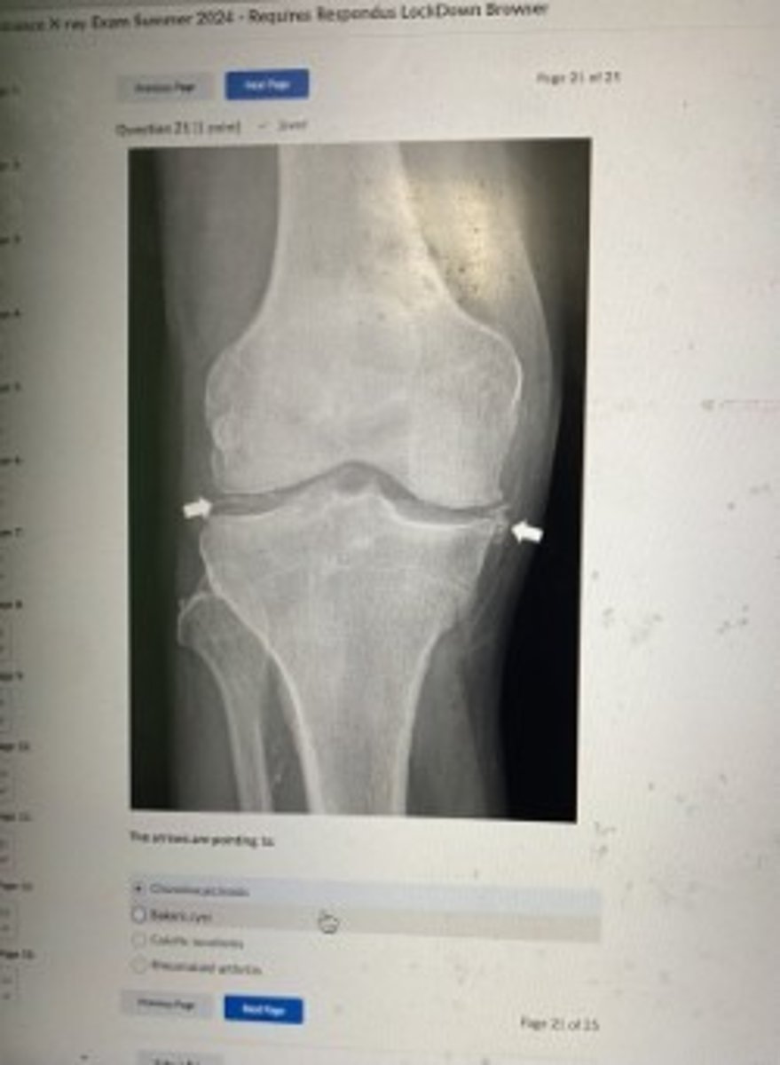 <p>Chondrocalcinosis</p>