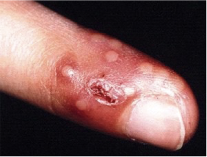 <p>What does this refer to</p><ul><li><p>Viral infection of the pulp of the fingertip</p></li><li><p>Often confused with bacterial paronychia</p></li><li><p>Characterized by</p><ul><li><p>MC terminal phalanx</p></li><li><p>Clear vesicles grouped on erythematous bases</p></li><li><p>May be on more than 1 finger</p></li></ul></li></ul><p></p>