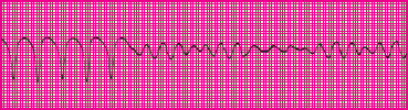 <p>Which rhythm is this?</p>