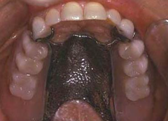 <p>ID the type of maxillary major connector:</p>
