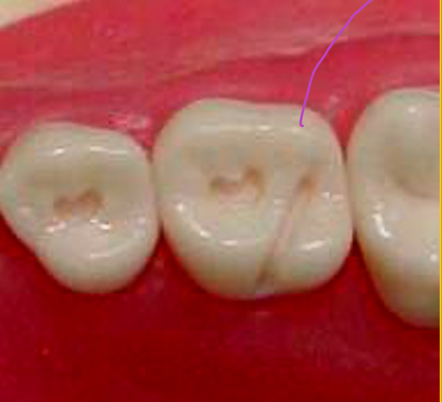 <p>oblique ridges</p>