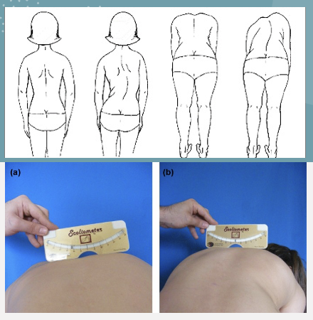 <p>presence of structural scoliosis </p>