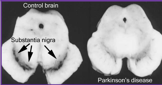 <p>Substantia Nigra (in BS)</p>