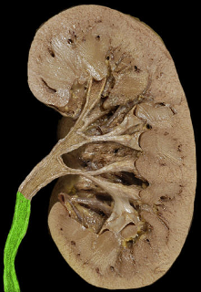 <p>renal ureter</p>