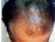<p>Androgenetic Alopecia (aka male pattern baldness) tx*</p>
