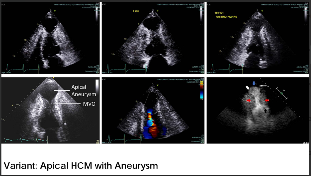 <p>An apical aneurysm is a <strong>discrete, thin-walled dyskinetic or akinetic segment</strong> of the most distal portion of the chamber, with a relatively <strong>wide communication to the LV cavity</strong>.</p>