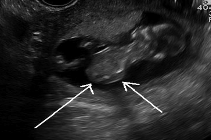 <p>caudal regression syndrome is strongly associated with </p>
