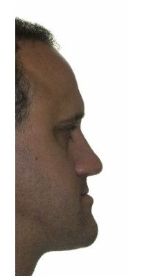 <p>Prognathic</p>
