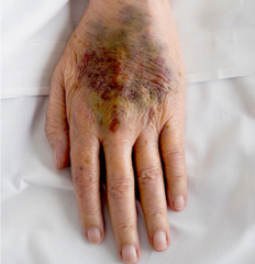 <p>-ecchymosis </p><p>-immediate swelling at the site </p><p>-blood leaking from insertion site</p>