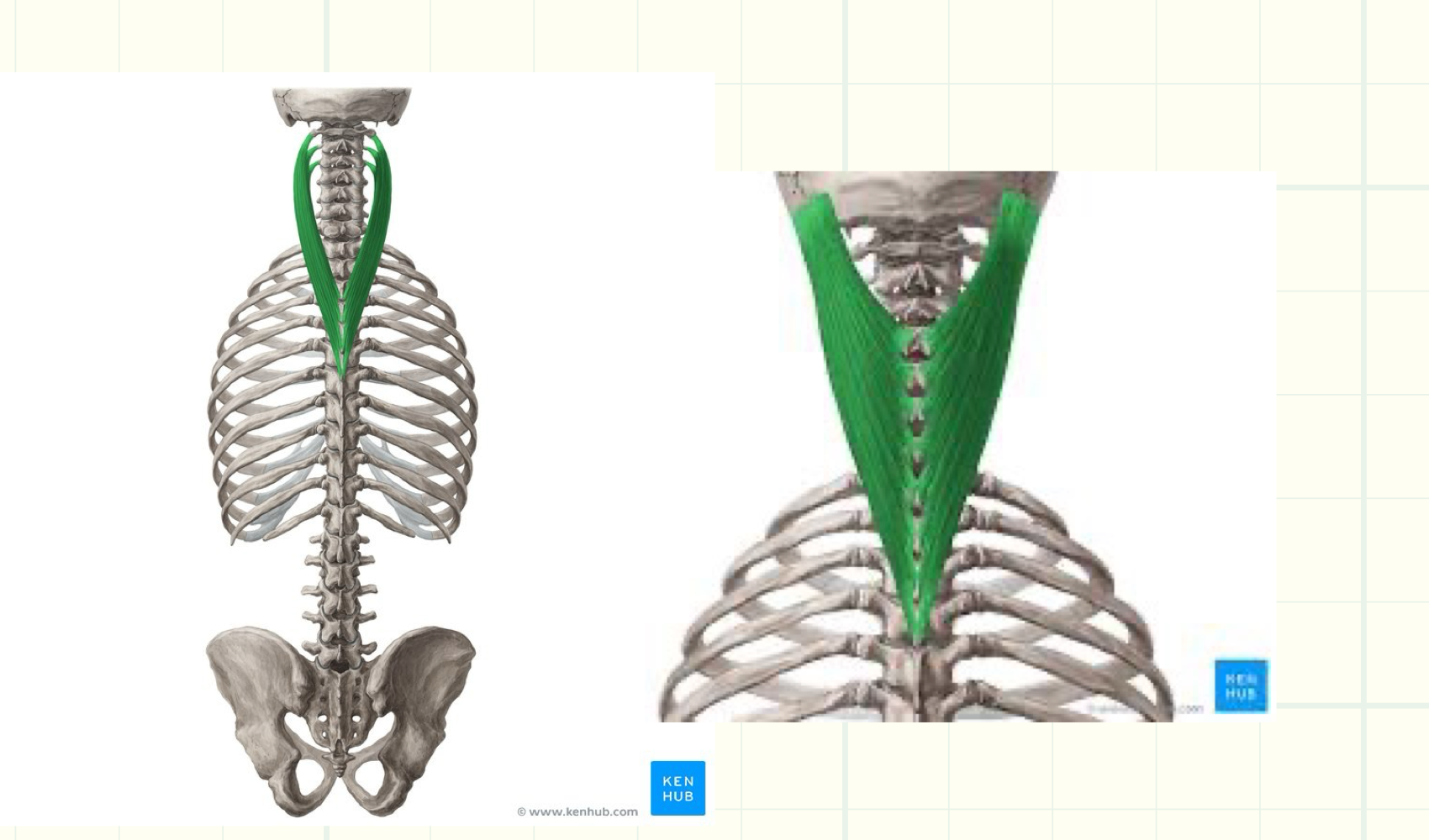 <p>Origin: arises from nuchal ligament and spinous processes of C7-T6 vertebrae</p><p>Insertion: mastoid process of temporal bone and superior nuchal line of occipital bone (capitis), tubercles of transverse processes of C1-C3 or C4 vertebrae (cervicis)</p><p>Innervation: posterior rami of spinal nerves</p><p>Action: laterally flex, rotate to same side (unilateral), extend head and neck (bilateral)</p>