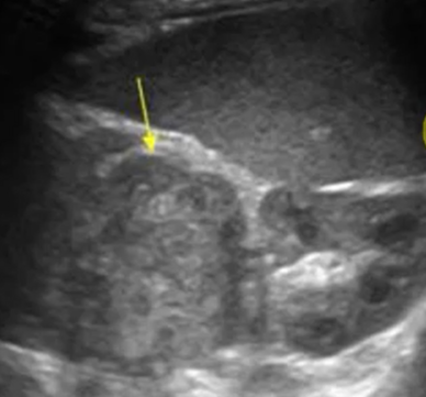 <p>Heterogeneous, hyperechoic mass with poorly defined margins</p>