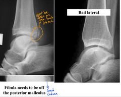 <p>Fibula needs to be off the posterior malleolus</p>