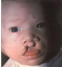 <ul><li><p>the <strong>central segment of the upper lip</strong> in a bilateral cleft lip.</p></li><li><p>occurs because philtrum columns did not fuse</p></li></ul><p></p>