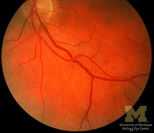 <p>crossing paths of an artery and vein in ocular fundus</p>