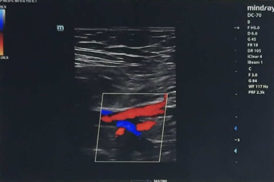 <p>Without changing transducer position, the color map is inverted.</p><p>What happens?</p>