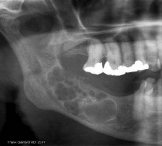 <p>A 25 year old patient present with mild swelling of lower jaw. Intra orally a small swelling was visible over right third molar region. A radiograph taken. Provide Differential diagnosis and justify</p>