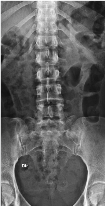 <p>L5 TPs may fuse or form joints with the sacrum </p>