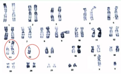 <p>- Karyotype → can be used to dx chromosomal imbalances</p>