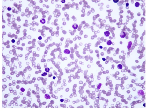 <p><strong>Identify the shown blood disorder and explain how it differs from normal blood.</strong></p>