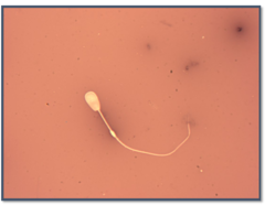 <p>Cytoplasmic droplets just proximal to the annulus </p><p>Normally shed as cells are mixed with seminal plasma and motility ensues as membrane stretches (much of cellular debris on spermiogram)</p><p>Sperm aberration does not appear to originate in the testis or epididymis </p><p>Previously considered a secondary abnormality</p><p>DOES NOT AFFECT FERTILITY</p>