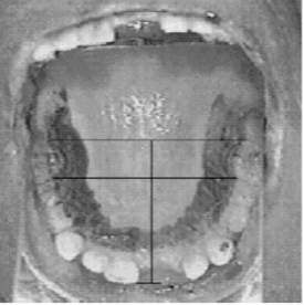 <p>narrow contact just behind the upper teeth</p>