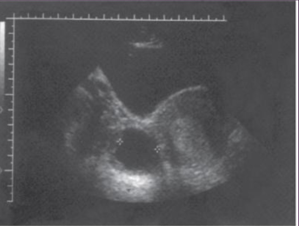 <p>Ruptured follicle transforms into corpus luteum, which produced progesterone and small amount of estrogen and prepares uterus for pregnancy; during pregnancy corpus luteum may enlarge; endometrium becomes thick</p>