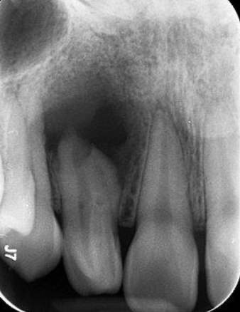 <p>What is the anatomical variation in this lateral incisor?</p>