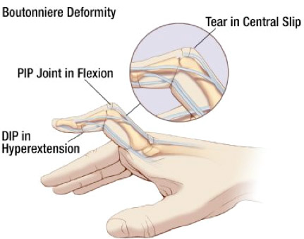 <p>DIP hyperextended, PIP stuck in flexion due to injury to extensor </p><p></p><p>PIP joint flexed inward and DIP extension outward due to injury to extensor at PIP joint, specifically the central slip, or fracture the bone at attachment caused by forceful blow to back of finger of bent finger, or direct injury to extensor tendon</p>