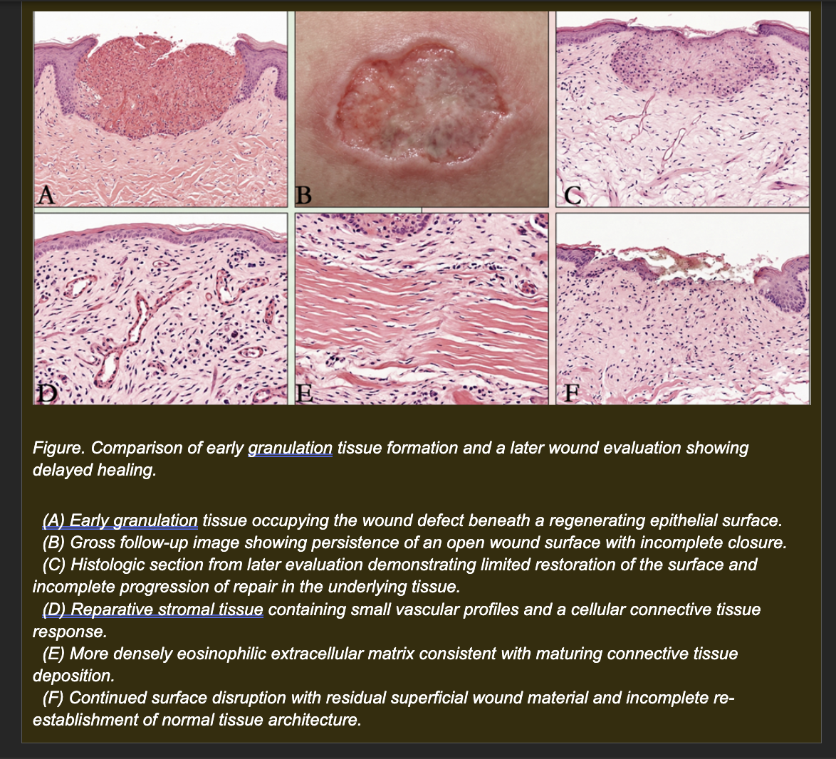<p>A horse sustains a large open wound on the distal forelimb that cannot be sutured closed due to tissue loss. The wound is managed conservatively. Over the following 7-10 days, the wound bed fills progressively with bright red, moist, granular tissue. Histologic examination at day 10 shows:</p><p>- Numerous small new blood vessels (neovascular channels) in a loose connective tissue matrix</p><p>- Abundant fibroblasts actively depositing collagen</p><p>- Scattered macrophages phagocytosing debris</p><p>- The granulation tissue surface begins to be covered by migrating epithelial cells at the wound margins</p><p></p><p><strong>Which interpretation best explains the role of the granulation tissue in this wound?</strong></p><p>a. Angiogenesis restores oxygen and nutrient delivery to the wound bed while fibroblasts produce the collagen matrix that fills the defect and supports epithelial migration and subsequent scar maturation</p><p>b. New blood vessels prevent leukocyte entry into the wound while fibroblasts produce inflammatory mediators that maintain the acute inflammatory response</p><p>c. Fibroblasts produce scar tissue that permanently replaces the wound defect while new blood vessels are a transient byproduct of the inflammatory response with no role in repair</p><p>d. Macrophages produce the collagen scaffold while fibroblasts remove the inflammatory exudate by phagocytosis</p>
