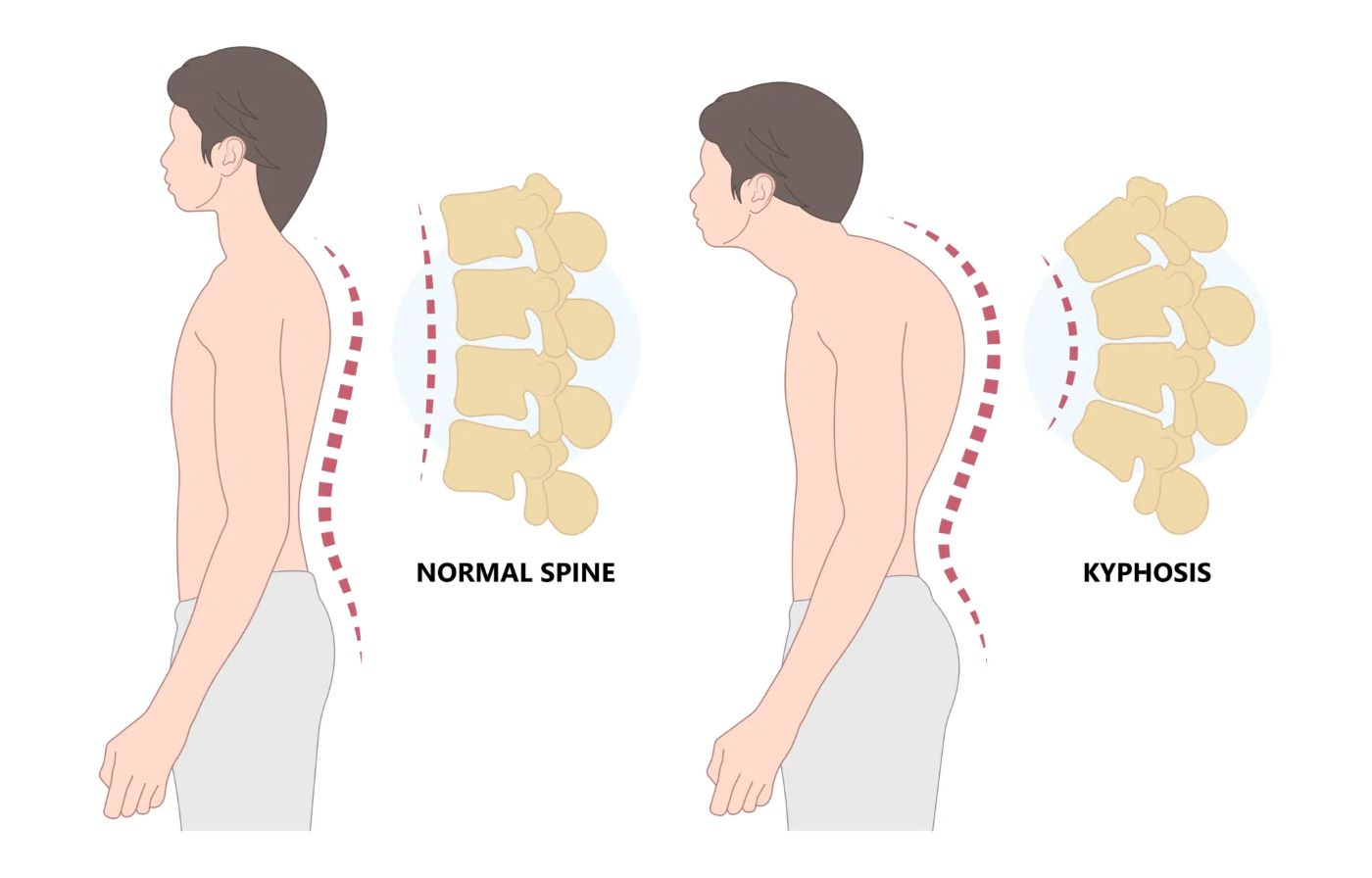 <p>Is kyphosis normal in older adults?</p>