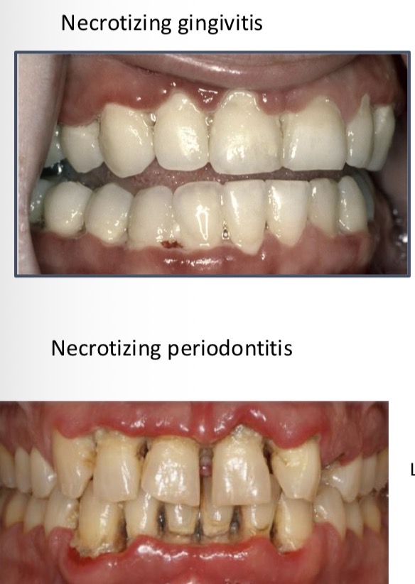 <p>Microbial disease causing <strong>death and destruction</strong> of gingival tissue </p><p>Previous acute respiratory disease, lifestyle- stress, tobacco, nutrition, altered immune system</p><p>Marginal gum</p><p>Crater-like depressions on crest of interdental papilla</p><p>Halitosis, hyper salivation, pain, metallic taste, spontaneous bleeding</p><p>Scaling and root planing - <span><span>Reversible- no loss of bone- papilla height given by bone so papilla can grow back</span></span></p>