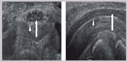 <ul><li><p><span style="background-color: transparent;">Nerve fiber enclosed by hyperechoic epineurium&nbsp;</span></p></li><li><p><span style="background-color: transparent;">LAX</span></p><ul><li><p><span style="background-color: transparent;">“Railroad” or “tram track”</span></p></li><li><p><span style="background-color: transparent;">Hypoechoic nerve fibers divided by hyperechoic perineurium</span></p></li></ul></li><li><p><span style="background-color: transparent;">SAX </span></p><ul><li><p><span style="background-color: transparent;">“Honeycomb” pattern</span></p></li><li><p><span style="background-color: transparent;">Hypoechoic nerve fibers surrounded by hyperechoic perineurium</span></p></li></ul></li></ul><p></p>