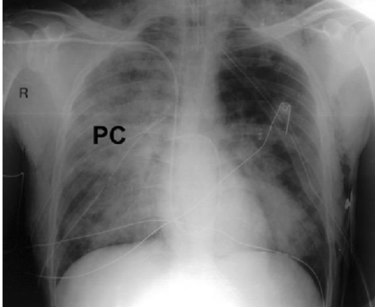 <p>ICG: is this a pulmonary contusion, pneomothorax, or hemothorax</p>