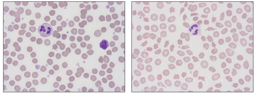 <p>Laboratory Features of Haemolytic Anaemia - Extravascular</p>