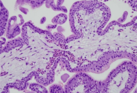 <p><span style="font-family: "Times New Roman", serif; line-height: 115%;"><span>Durante el desarrollo de placenta las </span></span><span style="font-family: "Times New Roman", serif; line-height: 115%; color: rgb(225, 33, 87);"><strong><span>células mesodérmicas</span></strong></span><span style="font-family: "Times New Roman", serif; line-height: 115%;"><span> de las vellosidades coriónicas invaden centro de vellosidad primaria en dirección de la decidua, en qué fase ocurre:</span></span></p>