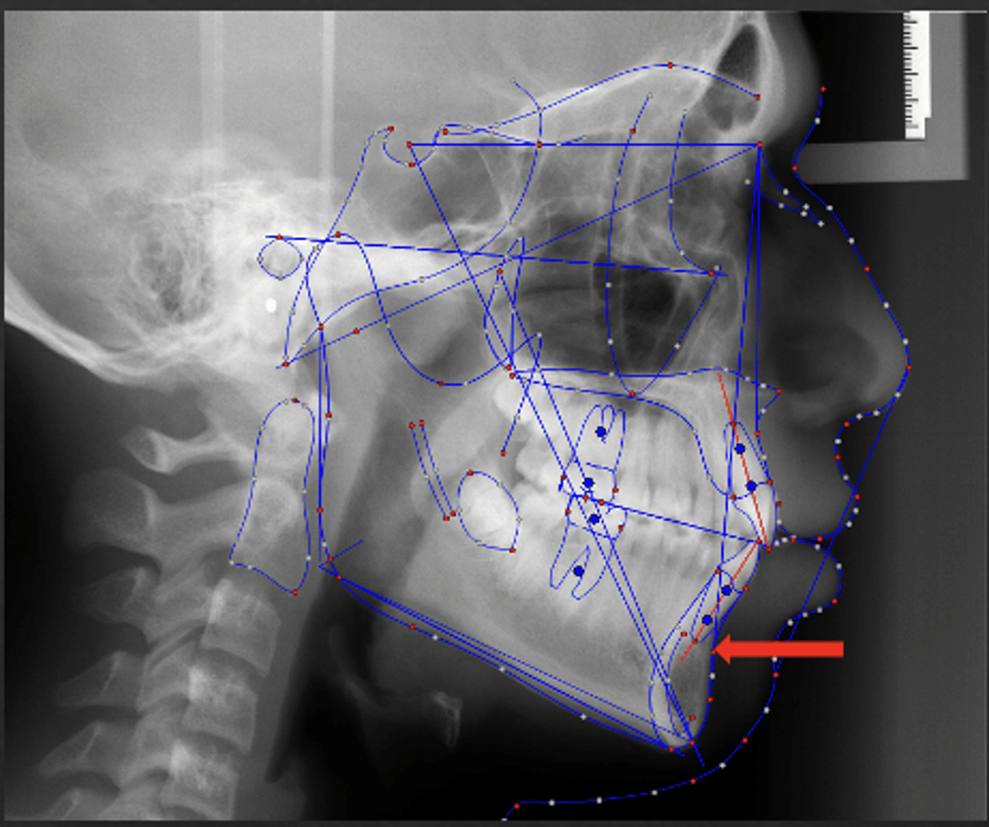 <p>which anatomical landmark:</p><p>- Most posterior point in the concavity along the anterior border of the symphysis</p>