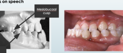 <p>lower jaw is large and/or the upper jaw is small</p><p>the buccal groove is ahead of the cusp</p><p>common in cleft lip and palates due to post surgical scarring</p>