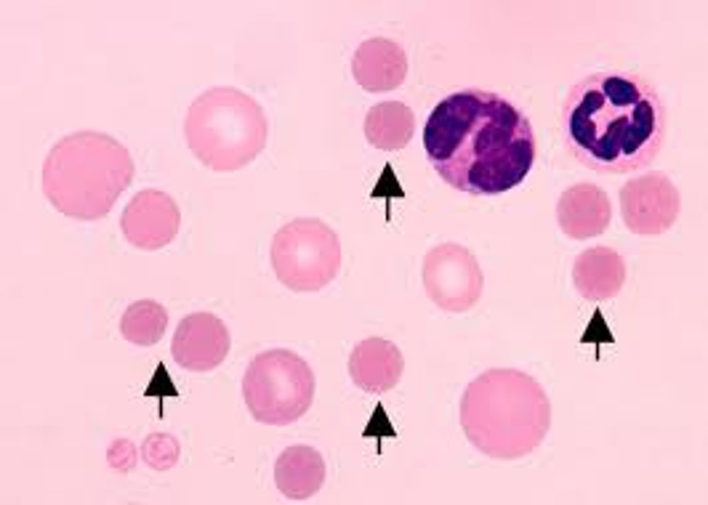 <p>Hyperchromic cells</p>