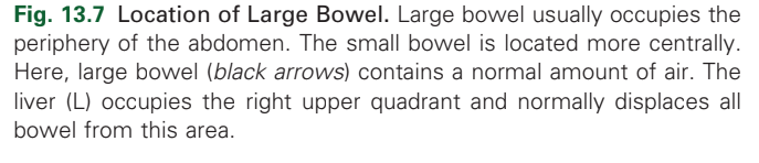 <p>Large bowel with normal amounts of air</p>