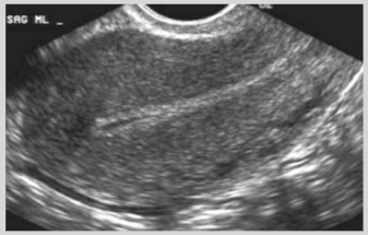 <ul><li><p><span style="background-color: transparent;">Evacuation of all products of conception</span></p></li><li><p><span style="background-color: transparent;">Clinical signs:</span></p><ul><li><p><span style="background-color: transparent;">Rapid decline of HCG levels</span></p></li><li><p><span style="background-color: transparent;">Vaginal bleeding w/ tissue/clots</span></p></li><li><p><span style="background-color: transparent;">Cramping&nbsp;</span></p></li><li><p><span style="background-color: transparent;">Disappearance of pregnancy symptoms</span></p></li><li><p><span style="background-color: transparent;">Cessation of pain and bleeding after conceptus is passed</span></p></li></ul></li><li><p>US findings:</p><ul><li><p><span style="background-color: transparent;">Empty uterus with “clean” endometrial stripe</span></p></li><li><p><span style="background-color: transparent;">Uterine enlargement</span></p></li></ul></li></ul><p></p>