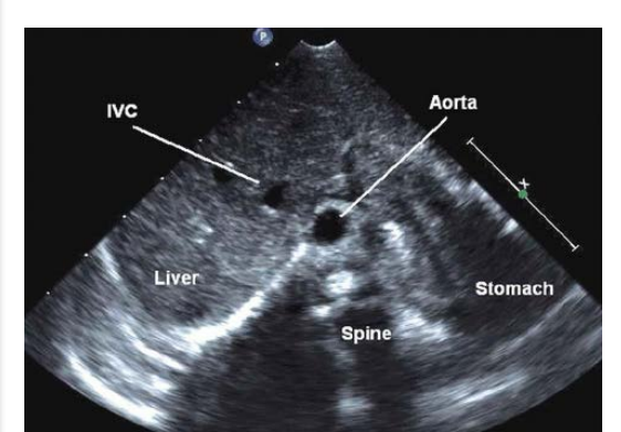 <p>RA is on the right • </p><p>Aorta on the left •</p><p> Liver on the right </p><p>• IVC anterior and to the right of the aorta </p><p>• Right sided trilobed lung </p><p>• Left sided bi lobed lung •</p><p> Left sided stomach</p><p> • Left sided spleen</p>