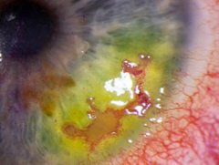 <p>Pain, visual blurring, watery discharge</p><p>Exam: chemosis, decreased corneal sensation, dendritic lesions of the cornea, corneal ulcers</p>