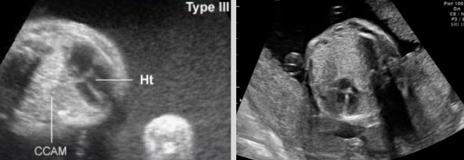 <ul><li><p><span style="background-color: transparent;">Microcysts or noncystic lesions w/ mediastinal shift&nbsp;</span></p></li><li><p><span style="background-color: transparent;">Mediastinal shift + lateral displacement of heart</span></p></li></ul><p></p>